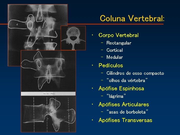 Coluna Vertebral: • Corpo Vertebral – – – Rectangular Cortical Medular • Pedículos –