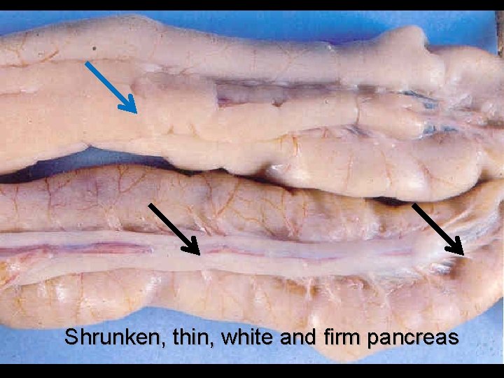 Shrunken, thin, white and firm pancreas 