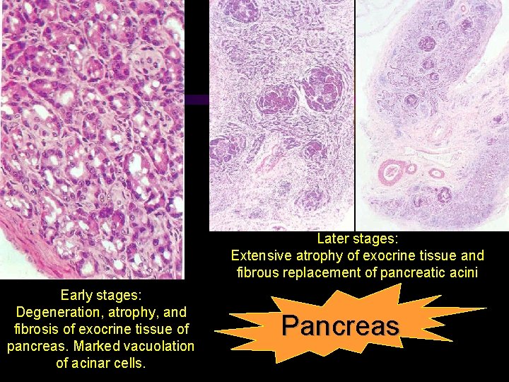 Later stages: Extensive atrophy of exocrine tissue and fibrous replacement of pancreatic acini Early