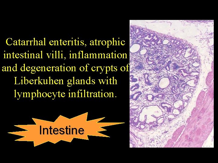 Catarrhal enteritis, atrophic intestinal villi, inflammation and degeneration of crypts of Liberkuhen glands with