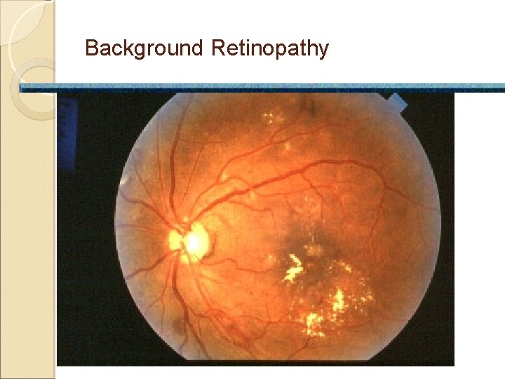 Background Retinopathy 