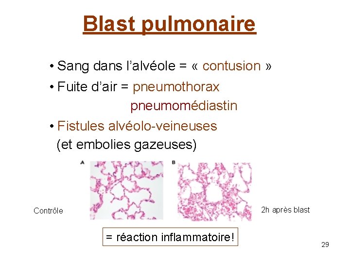 Blast pulmonaire • Sang dans l’alvéole = « contusion » • Fuite d’air =