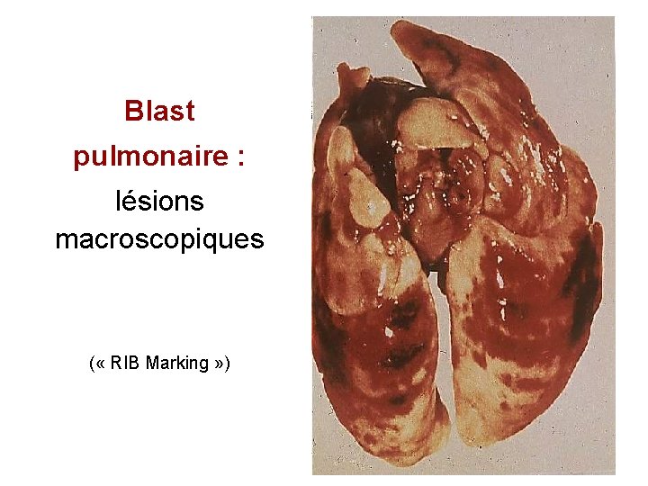Blast pulmonaire : lésions macroscopiques ( « RIB Marking » ) 30 