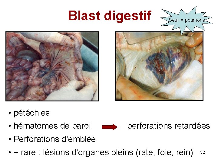 Blast digestif Seuil = poumons • pétéchies • hématomes de paroi perforations retardées •