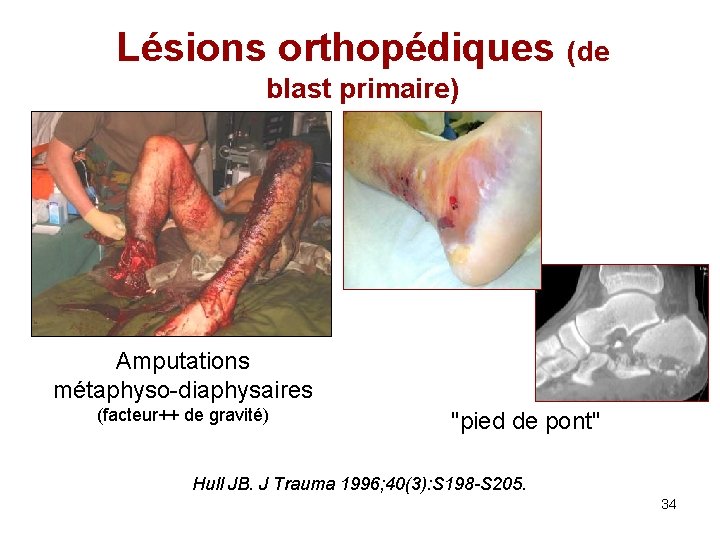 Lésions orthopédiques (de blast primaire) Amputations métaphyso-diaphysaires (facteur++ de gravité) "pied de pont" Hull