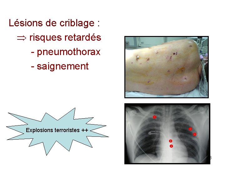 Lésions de criblage : risques retardés - pneumothorax - saignement Explosions terroristes ++ 38