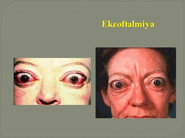 Ekzoftalmiya 