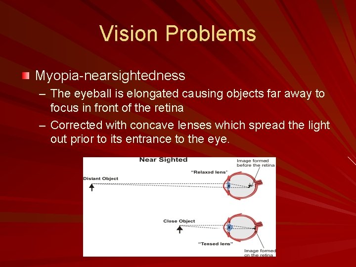 Vision Problems Myopia-nearsightedness – The eyeball is elongated causing objects far away to focus