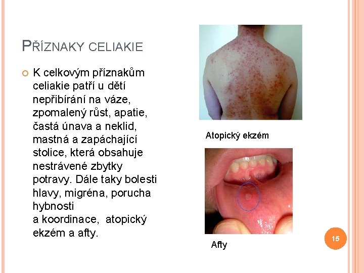 PŘÍZNAKY CELIAKIE K celkovým příznakům celiakie patří u dětí nepřibírání na váze, zpomalený růst,