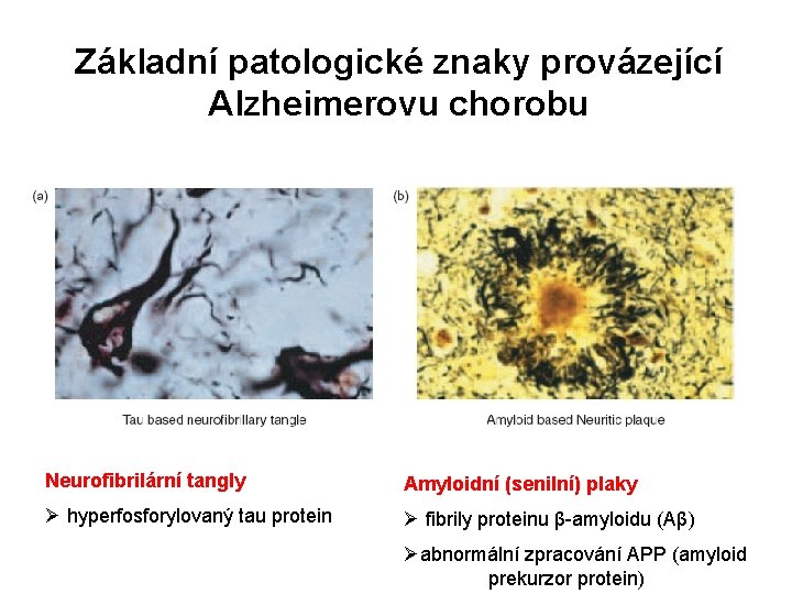 Základní patologické znaky provázející Alzheimerovu chorobu Neurofibrilární tangly Amyloidní (senilní) plaky Ø hyperfosforylovaný tau