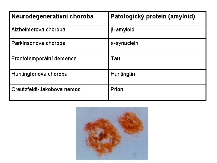 Neurodegenerativní choroba Patologický protein (amyloid) Alzheimerova choroba β-amyloid Parkinsonova choroba α-synuclein Frontotemporální demence Tau