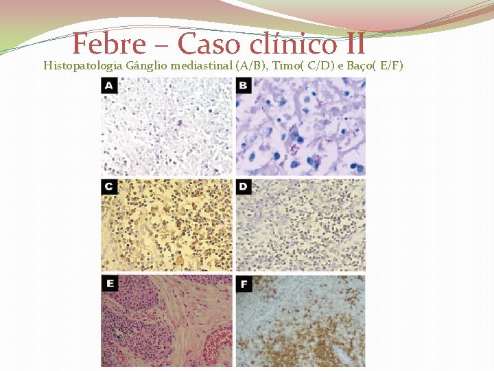  Febre – Caso clínico II Histopatologia Gânglio mediastinal (A/B), Timo( C/D) e Baço(