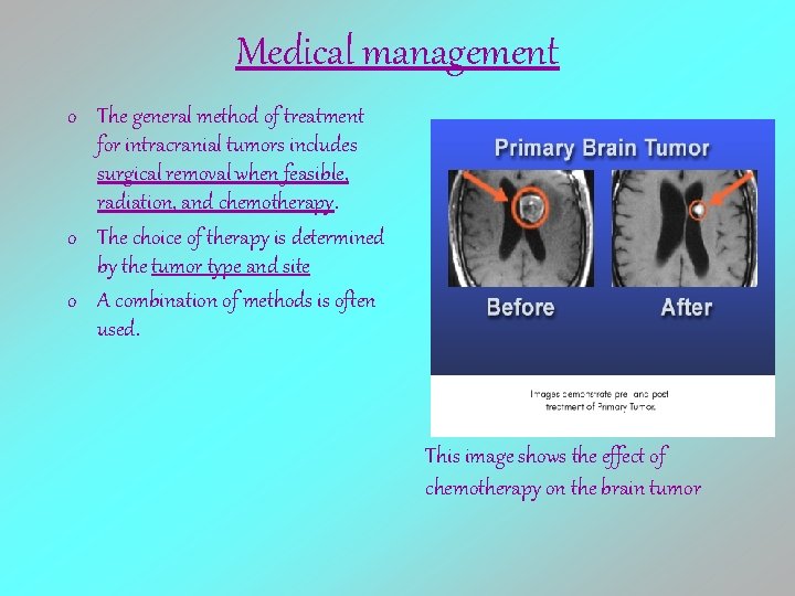 Medical management o The general method of treatment for intracranial tumors includes surgical removal