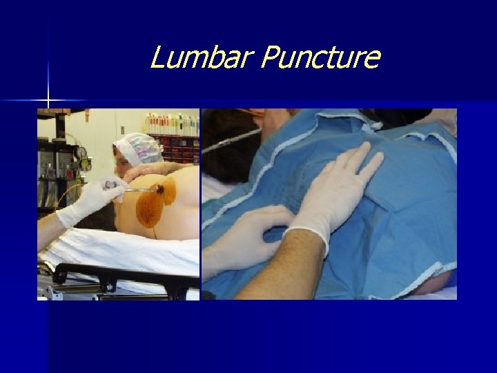 Lumbar Puncture 