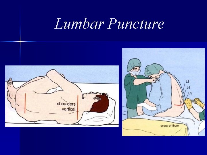 Lumbar Puncture 