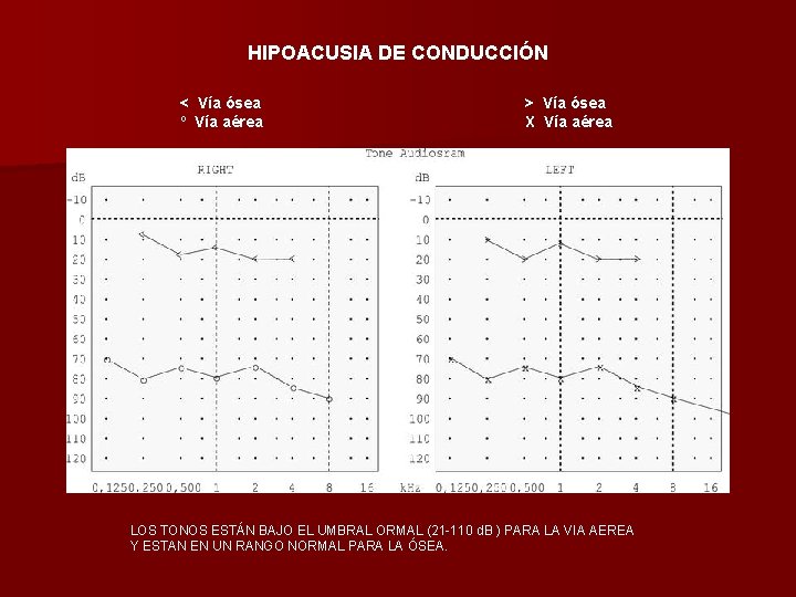 HIPOACUSIA DE CONDUCCIÓN < Vía ósea º Vía aérea > Vía ósea X Vía