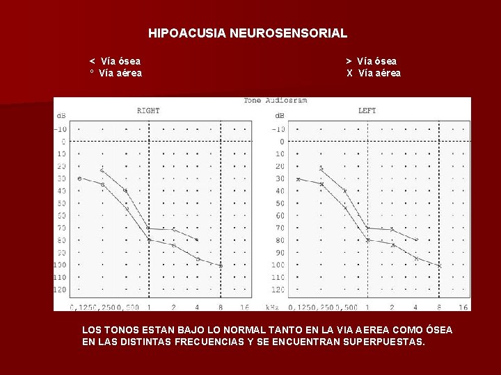 HIPOACUSIA NEUROSENSORIAL < Vía ósea º Vía aérea > Vía ósea X Vía aérea