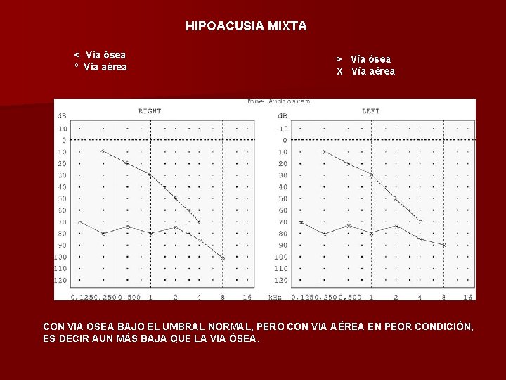 HIPOACUSIA MIXTA < Vía ósea º Vía aérea > Vía ósea X Vía aérea