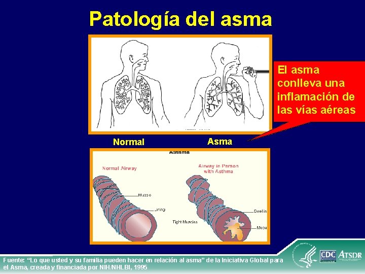 Patología del asma El asma conlleva una inflamación de las vías aéreas Normal Asma