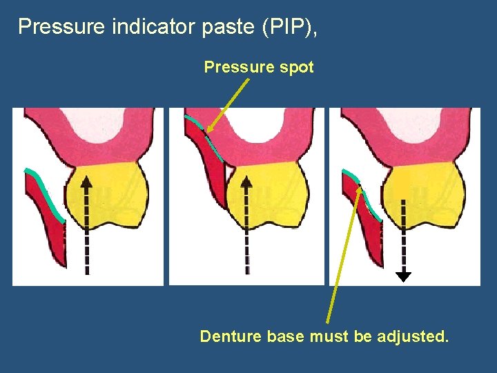 Pressure indicator paste (PIP), Pressure spot Denture base must be adjusted. 
