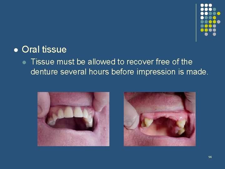 l Oral tissue l Tissue must be allowed to recover free of the denture