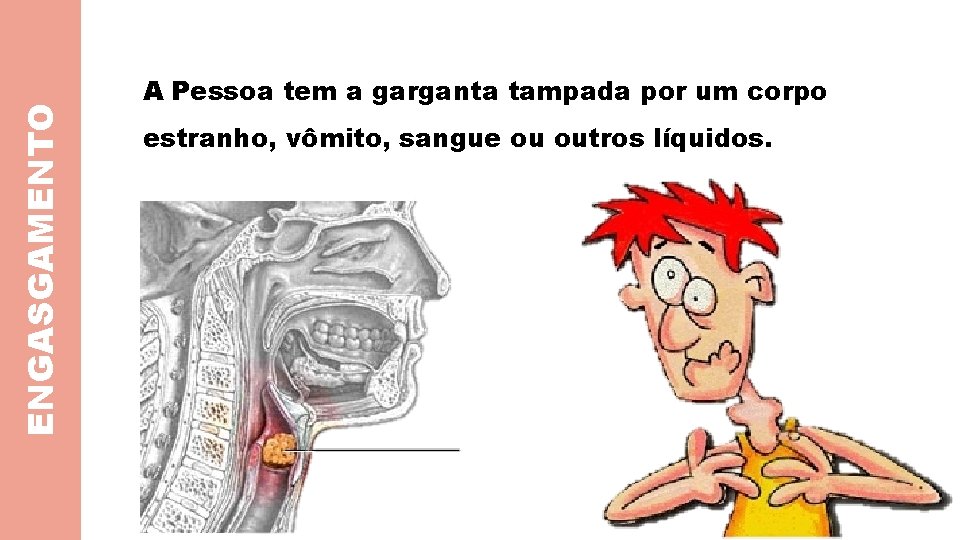 ENGASGAMENTO A Pessoa tem a garganta tampada por um corpo estranho, vômito, sangue ou