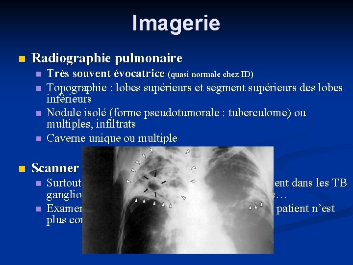 Imagerie Radiographie pulmonaire Très souvent évocatrice (quasi normale chez ID) Topographie : lobes supérieurs