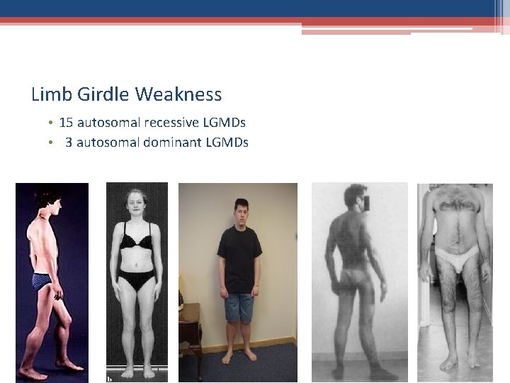 Limb Girdle Weakness • 15 autosomal recessive LGMDs • 3 autosomal dominant LGMDs 