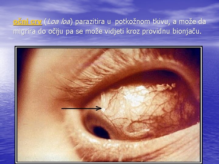  očni crv (Loa loa) parazitira u potkožnom tkivu, a može da migrira do