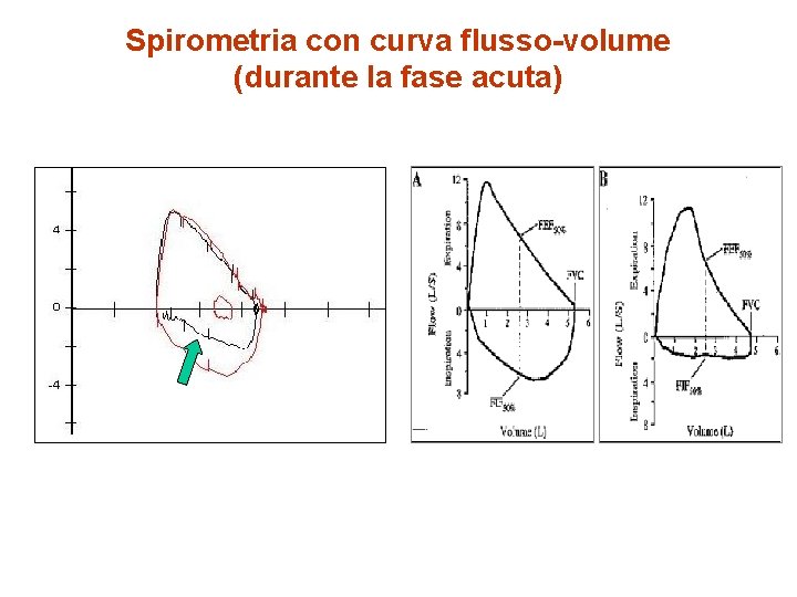 Spirometria con curva flusso-volume (durante la fase acuta) 