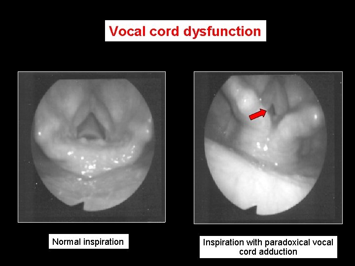 Vocal cord dysfunction Normal inspiration Inspiration with paradoxical vocal cord adduction 