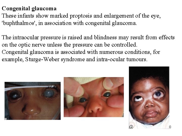 Congenital glaucoma These infants show marked proptosis and enlargement of the eye, 'buphthalmos', in