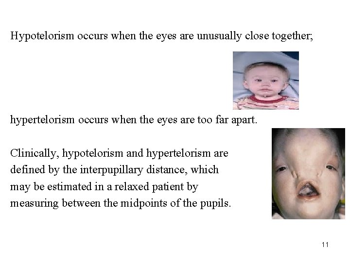 Hypotelorism occurs when the eyes are unusually close together; hypertelorism occurs when the eyes