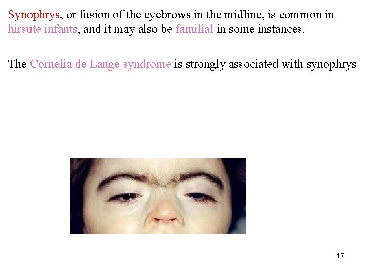 Synophrys, or fusion of the eyebrows in the midline, is common in hirsute infants,