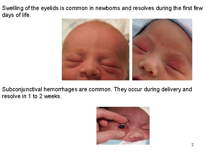 Swelling of the eyelids is common in newborns and resolves during the first few