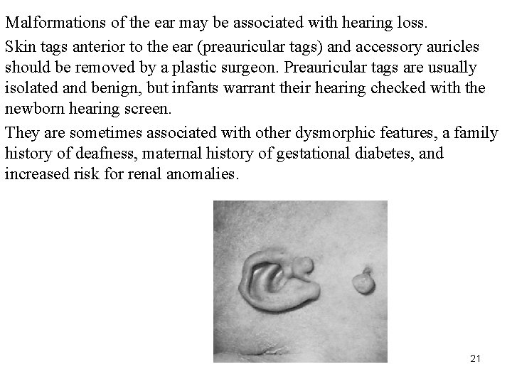 Malformations of the ear may be associated with hearing loss. Skin tags anterior to