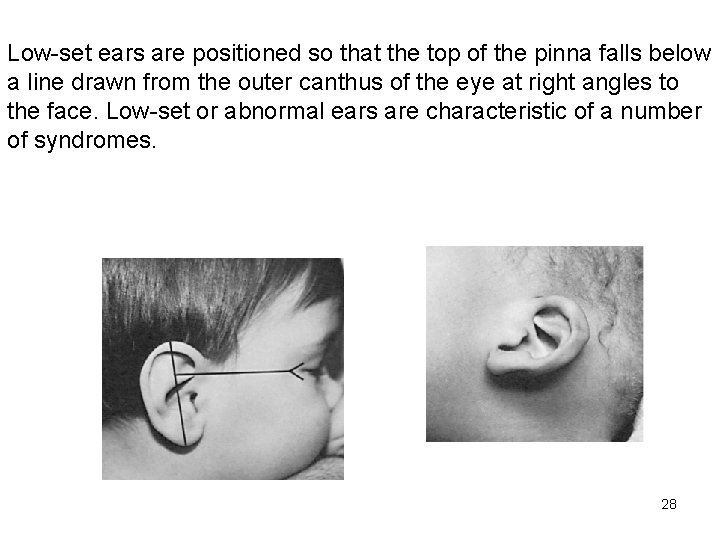 Low-set ears are positioned so that the top of the pinna falls below a