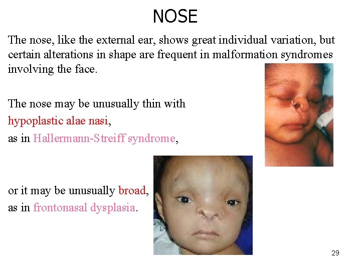 NOSE The nose, like the external ear, shows great individual variation, but certain alterations