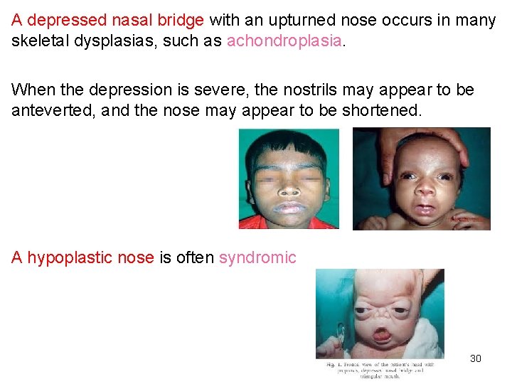 A depressed nasal bridge with an upturned nose occurs in many skeletal dysplasias, such