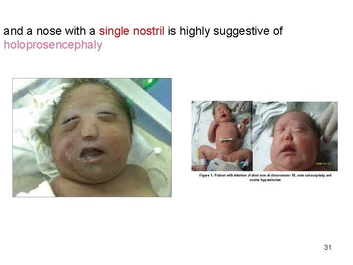 and a nose with a single nostril is highly suggestive of holoprosencephaly 31 