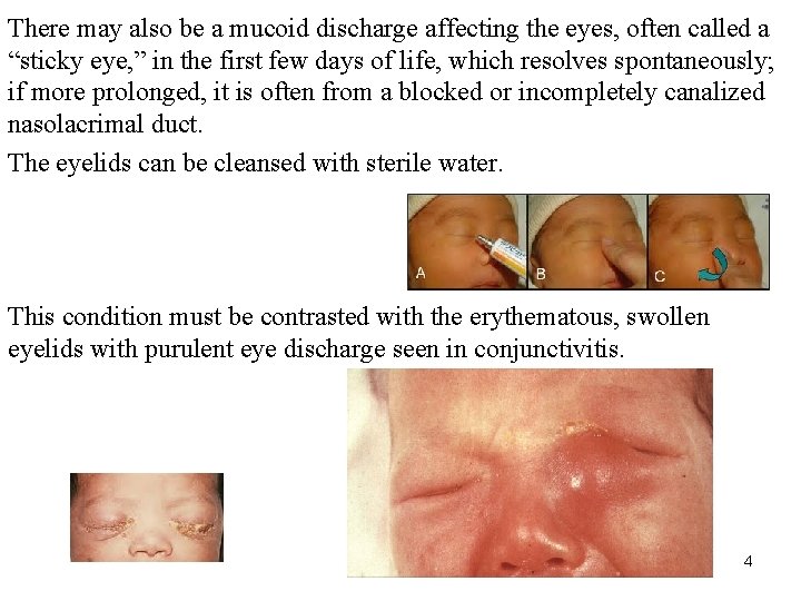 There may also be a mucoid discharge affecting the eyes, often called a “sticky