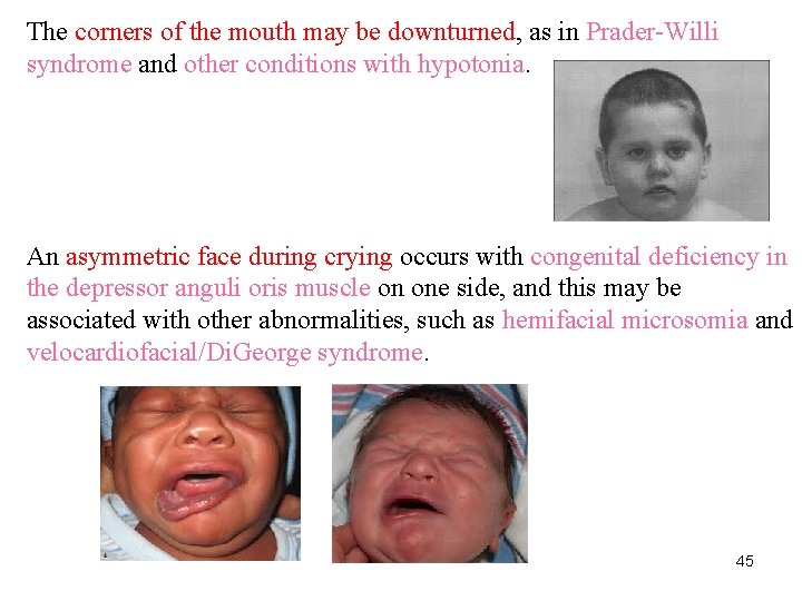 The corners of the mouth may be downturned, as in Prader-Willi syndrome and other