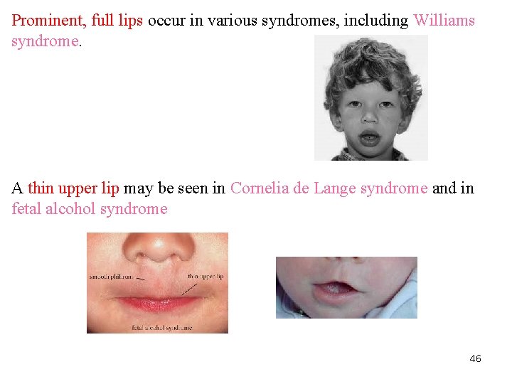 Prominent, full lips occur in various syndromes, including Williams syndrome. A thin upper lip