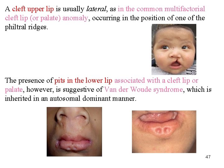 A cleft upper lip is usually lateral, as in the common multifactorial cleft lip