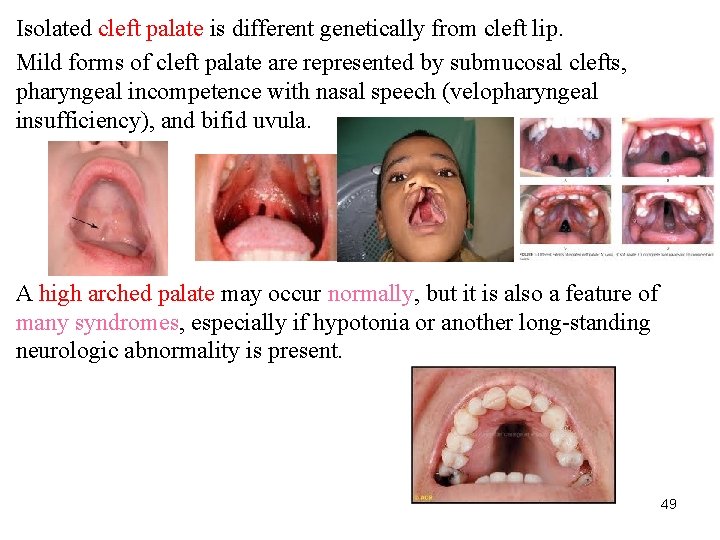 Isolated cleft palate is different genetically from cleft lip. Mild forms of cleft palate