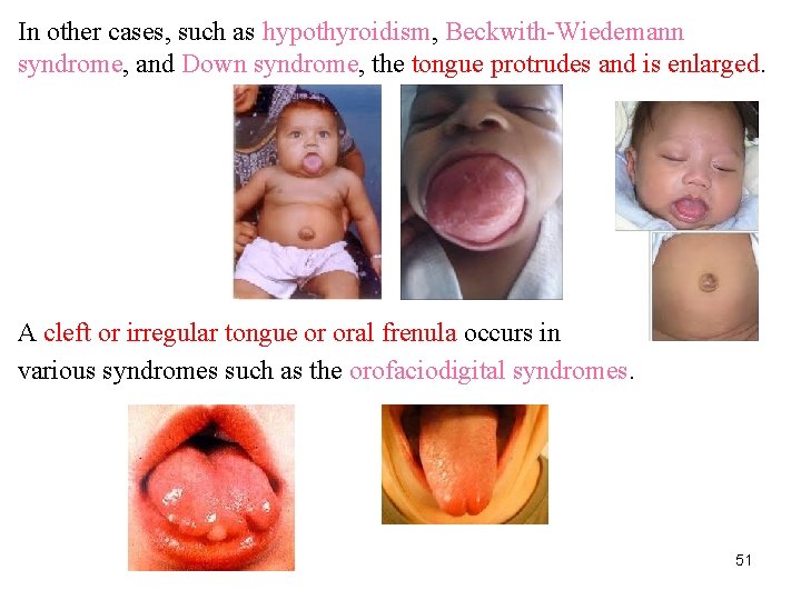 In other cases, such as hypothyroidism, Beckwith-Wiedemann syndrome, and Down syndrome, the tongue protrudes