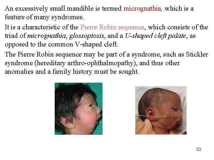 An excessively small mandible is termed micrognathia, which is a feature of many syndromes.