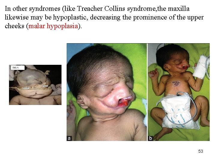 In other syndromes (like Treacher Collins syndrome, the maxilla likewise may be hypoplastic, decreasing