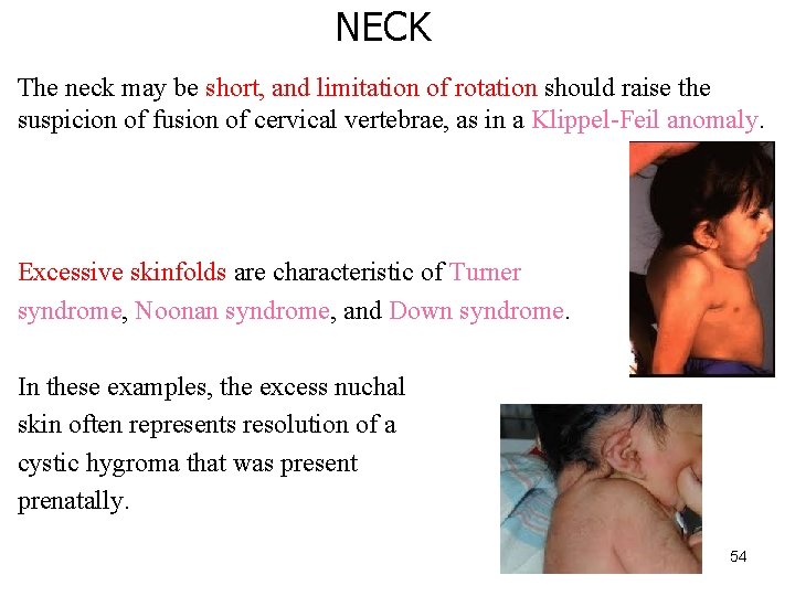 NECK The neck may be short, and limitation of rotation should raise the suspicion