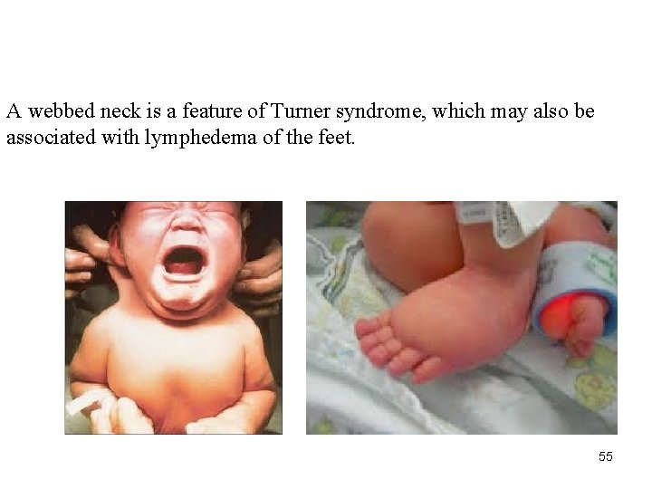 A webbed neck is a feature of Turner syndrome, which may also be associated